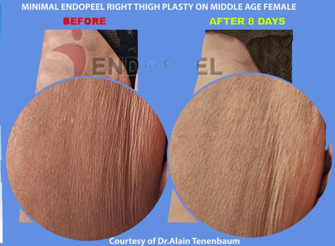 zoom plus post lipo right thigh plasty 