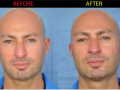 medical rhinoplasty endopeel